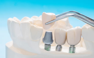 Missing Teeth? Why dental implants should be your next step