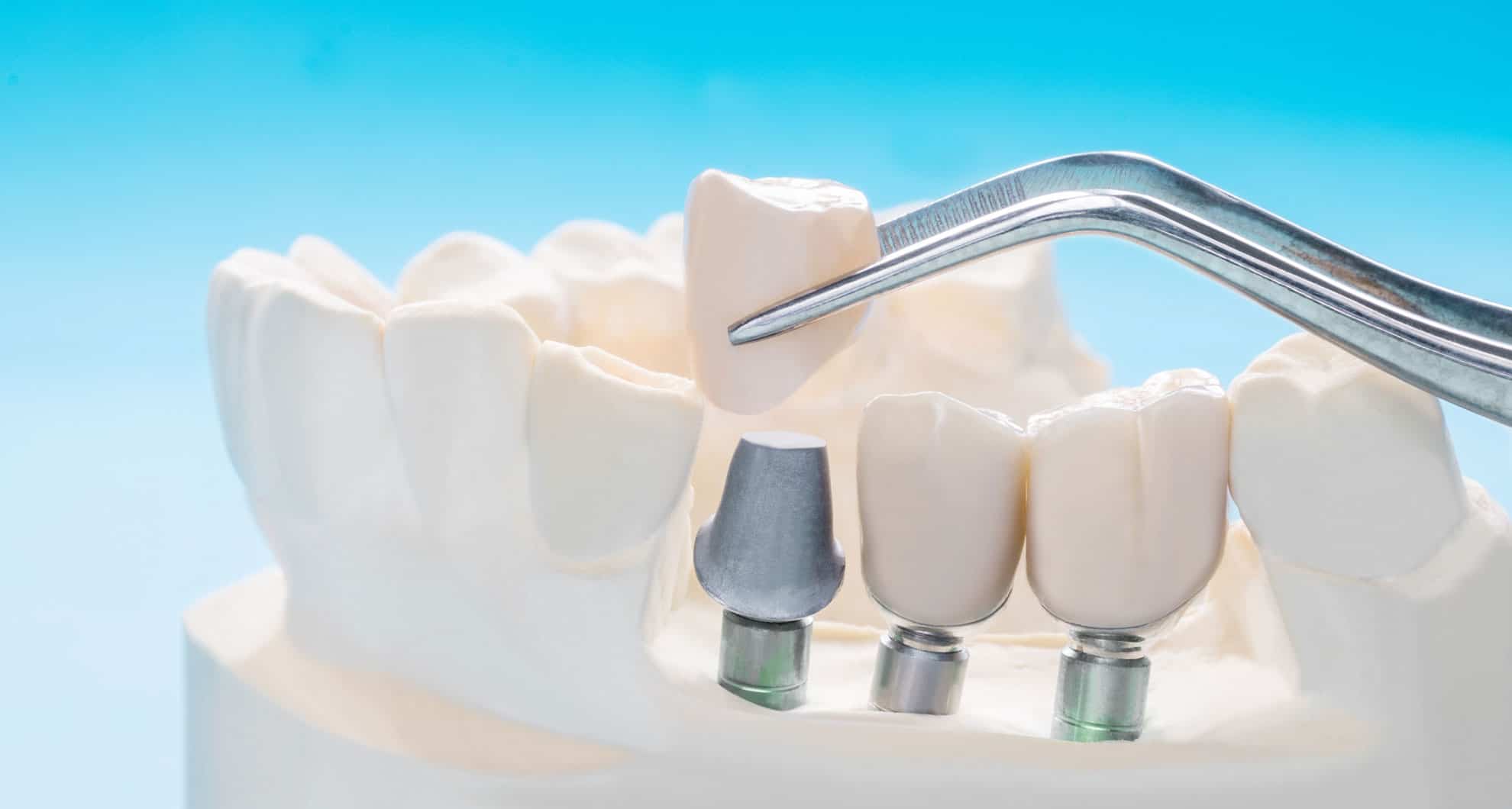 Титановый зубной имплант. Титан имплант. Аллергия на титановые импланты. Имплантат импро. Аллергия на титановые импланты.