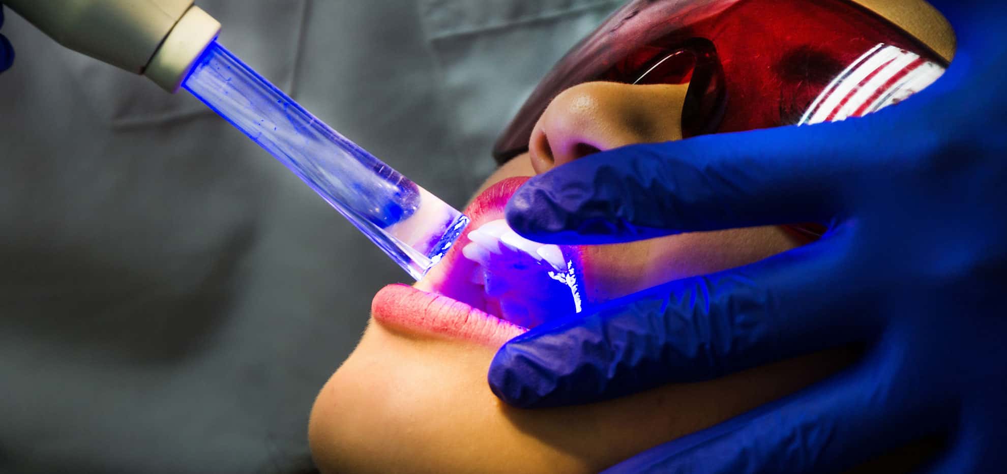 Dental Filling Laser at Aaron McGowan blog