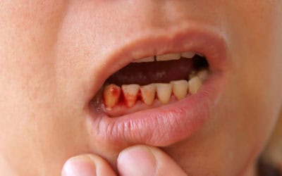 The Habits and Dental Issues that Can Cause Bleeding Gums
