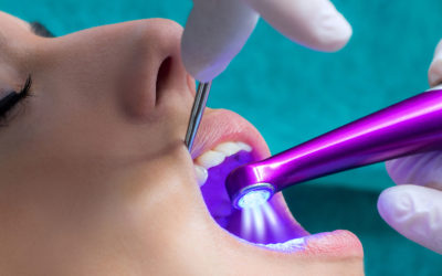 Important Tips About Dental Sealants