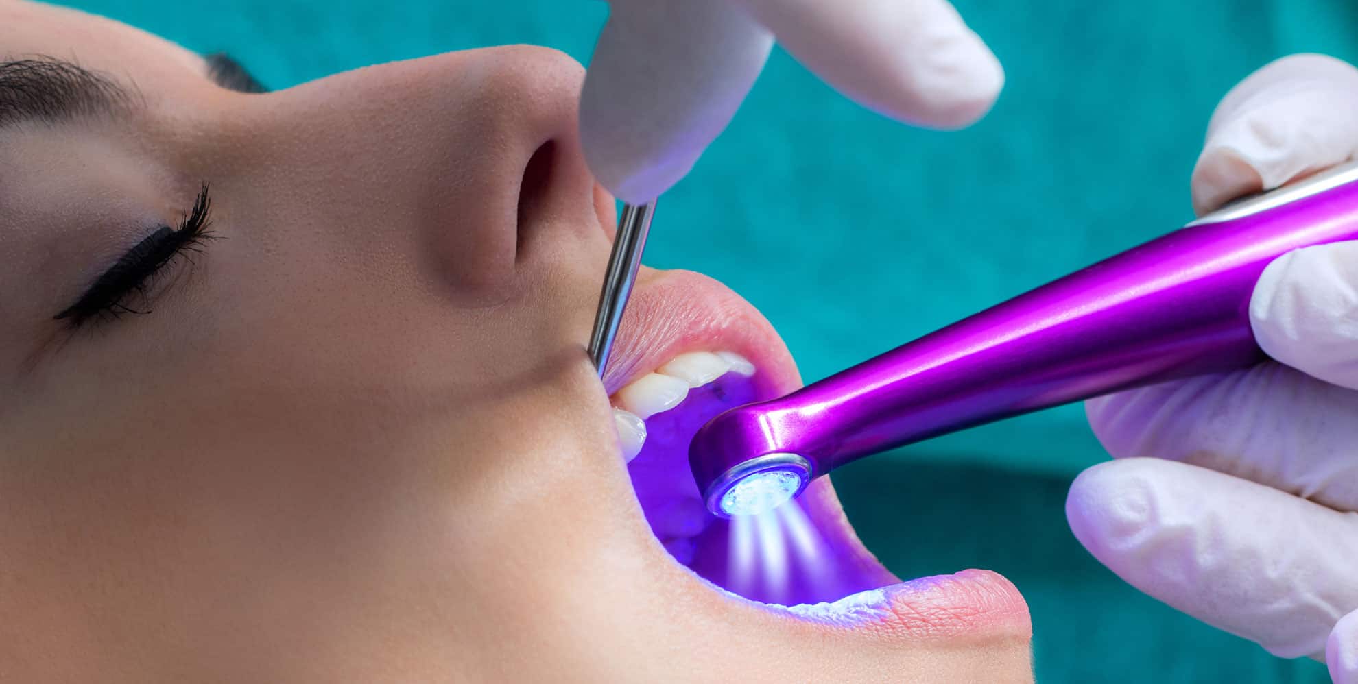 Important Tips About Dental Sealants Gateway Oaks Dental