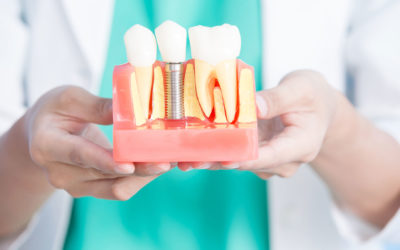 Dental Implant Placement Basics as a Step-by-Step Process