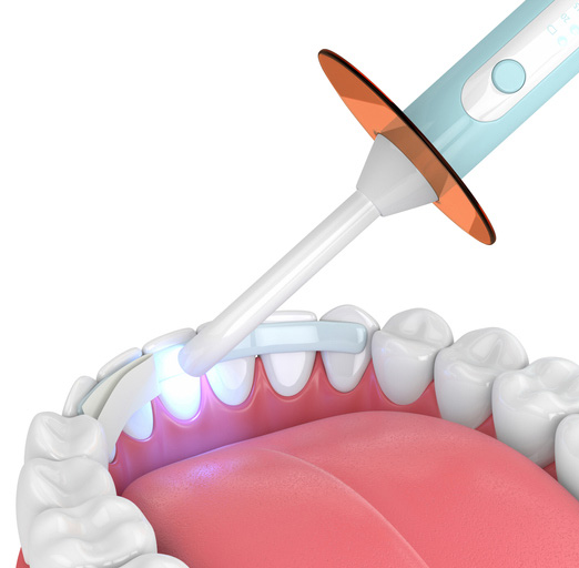 3d render of jaw with dental polymerization lamp and dental fiber