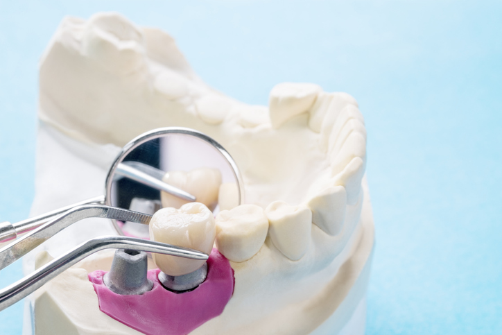 Implant Supported Dentures in Sacramento & Roseville, CA