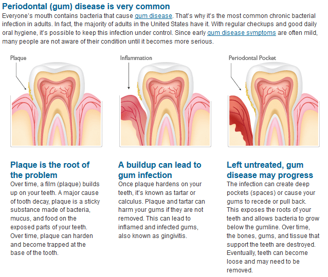 Gum_Disease_How