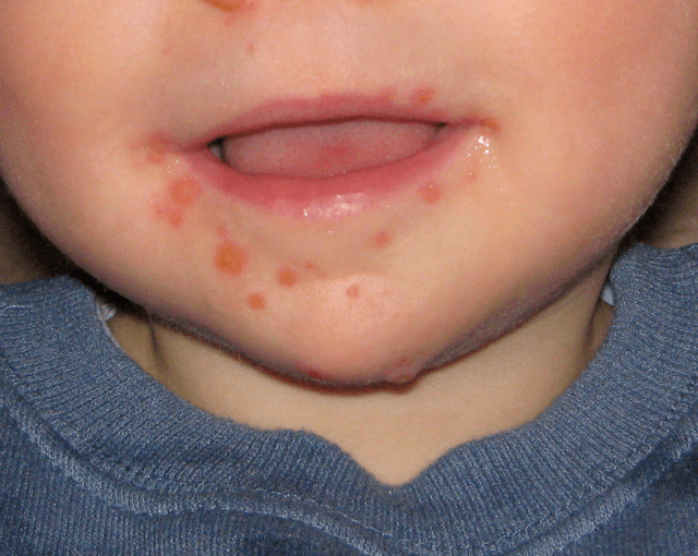Hand_Foot_Mouth_Disease