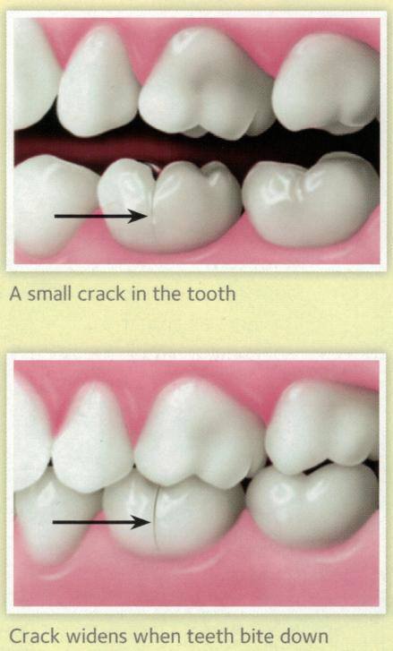How-can-you-tell-if-a-tooth-is-cracked