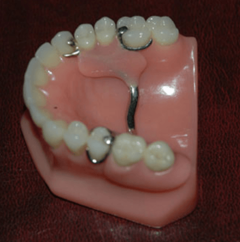 partial-denture-with-metal-clasps