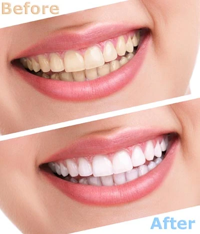 teeth whitening Sacramento CA